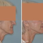 Facelift Before and After Photos in Miami, FL, Patient 1233
