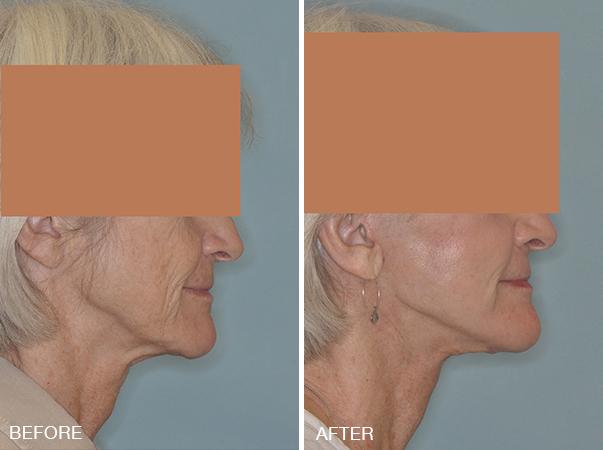 Facelift Before and After Photos in Miami, FL, Patient 1233
