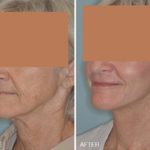 Facelift Before and After Photos in Miami, FL, Patient 1233