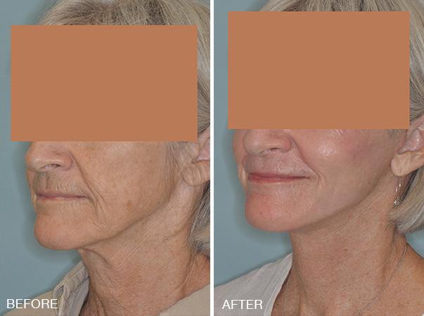 Facelift Before and After Photos in Miami, FL, Patient 1233