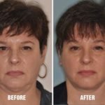 Facelift Before and After Photos in Miami, FL, Patient 1103