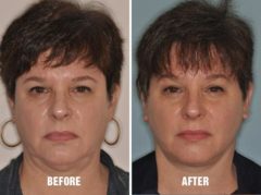 Facelift Before and After Photos in Miami, FL, Patient 1103