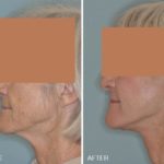 Facelift Before and After Photos in Miami, FL, Patient 1233