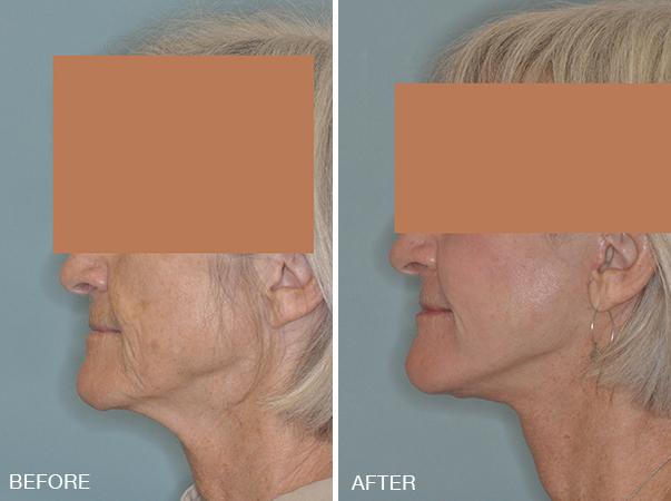 Facelift Before and After Photos in Miami, FL, Patient 1233