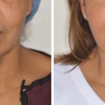 Facelift Before and After Photos in Miami, FL, Patient 1249