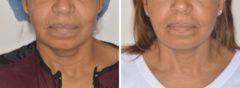 Facelift Before and After Photos in Miami, FL, Patient 1249