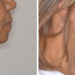 Facelift Before and After Photos in Miami, FL, Patient 1249