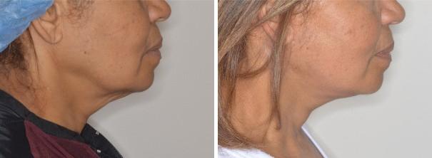 Facelift Before and After Photos in Miami, FL, Patient 1249