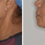 Facelift Before and After Photos in Miami, FL, Patient 1249