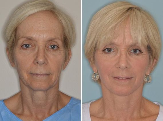 Facelift Before and After Photos in Miami, FL, Patient 1270