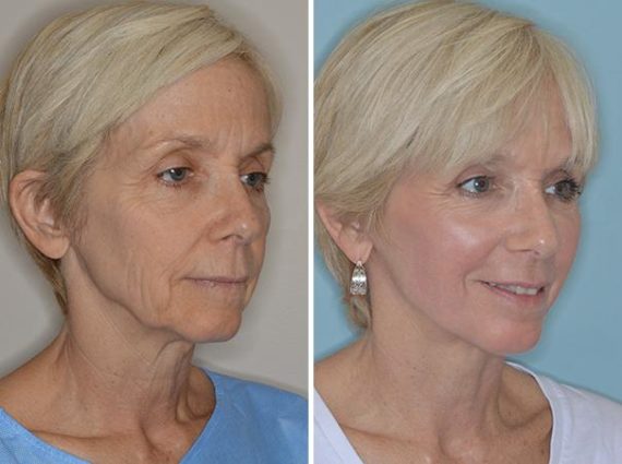 Facelift Before and After Photos in Miami, FL, Patient 1270