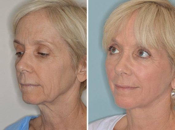 Facelift Before and After Photos in Miami, FL, Patient 1270