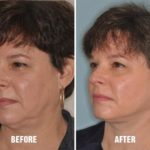 Facelift Before and After Photos in Miami, FL, Patient 1103