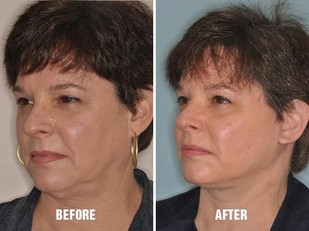 Facelift Before and After Photos in Miami, FL, Patient 1103