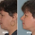 Facelift Before and After Photos in Miami, FL, Patient 1103