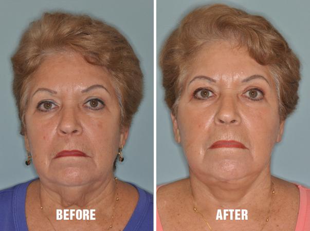 Facelift Before and After Photos in Miami, FL, Patient 1119