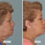Facelift Before and After Photos in Miami, FL, Patient 1119
