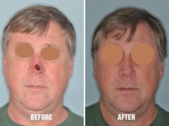 Facial Reconstruction Before and After Photos in Miami, FL, Patient 1288