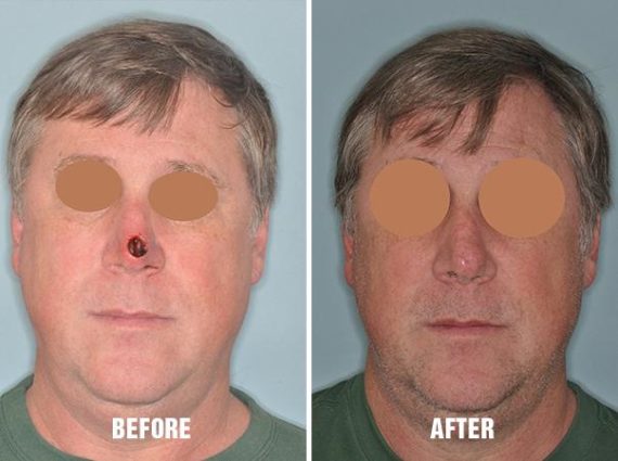 Facial Reconstruction Before and After Photos in Miami, FL, Patient 1288