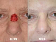 Facial Reconstruction Before and After Photos in Miami, FL, Patient 1292