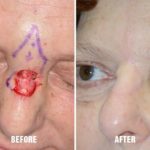 Facial Reconstruction Before and After Photos in Miami, FL, Patient 1292