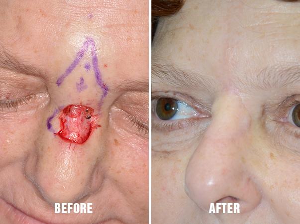 Facial Reconstruction Before and After Photos in Miami, FL, Patient 1292