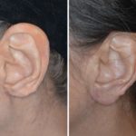 Earlobe Repair Before and After Photos in Miami, FL, Patient 1303