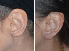 Earlobe Repair Before and After Photos in Miami, FL, Patient 1303