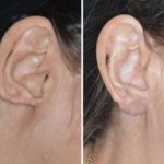 Earlobe Repair Before and After Photos in Miami, FL, Patient 1303