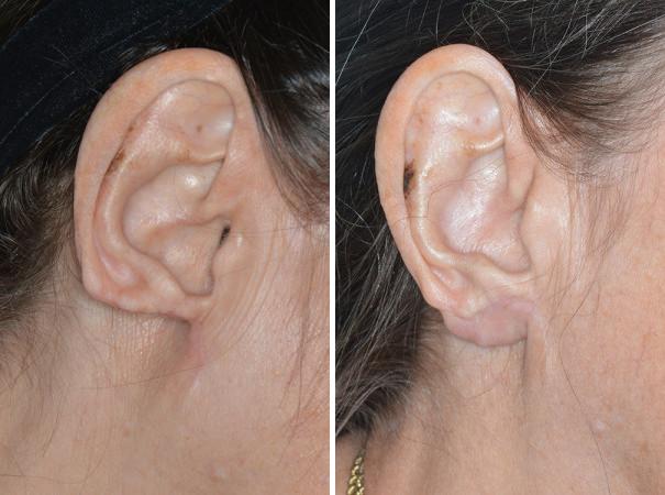 Earlobe Repair Before and After Photos in Miami, FL, Patient 1303