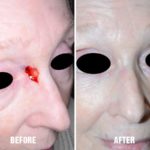 Facial Reconstruction Before and After Photos in Miami, FL, Patient 1308