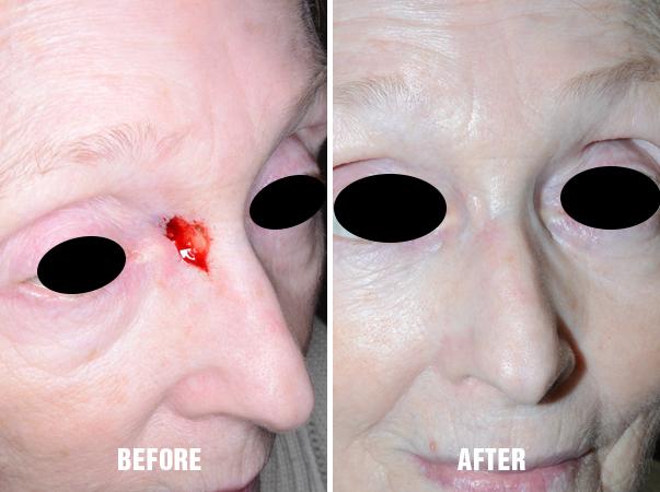 Facial Reconstruction Before and After Photos in Miami, FL, Patient 1308