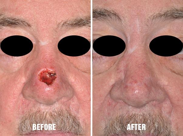 Facial Reconstruction Before and After Photos in Miami, FL, Patient 1310