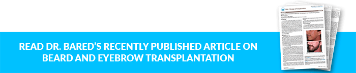 Read Dr. Bared's recently published article on Beard and Eyebrow Transplantation