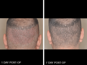 Hair Transplant - Miami Facial Plastic Surgery - Dr. Bared Hair Transplant - Miami Facial Plastic Surgery - Dr. Bared