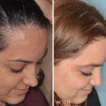 Hair Restoration Before and After Photos in Miami, FL, Patient 1578