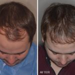 Hair Restoration Before and After Photos in Miami, FL, Patient 1614