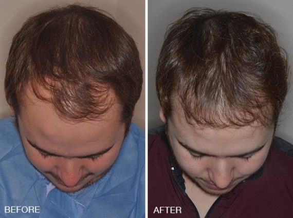 Hair Restoration Before and After Photos in Miami, FL, Patient 1614