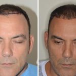 Hair Restoration Before and After Photos in Miami, FL, Patient 1623