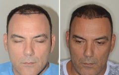 Hair Restoration Before and After Photos in Miami, FL, Patient 1623