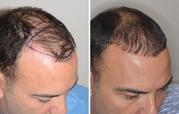 Hair Restoration Before and After Photos in Miami, FL, Patient 1623