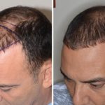 Hair Restoration Before and After Photos in Miami, FL, Patient 1623