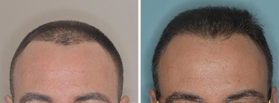 Hair Restoration Before and After Photos in Miami, FL, Patient 1633