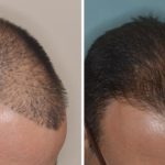 Hair Restoration Before and After Photos in Miami, FL, Patient 1633