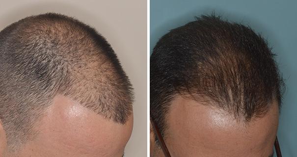 Hair Restoration Before and After Photos in Miami, FL, Patient 1633