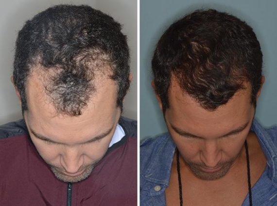 Hair Restoration Before and After Photos in Miami, FL, Patient 1641