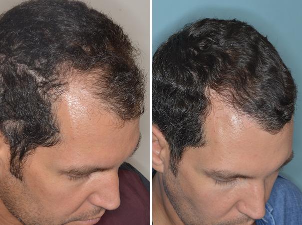 Hair Restoration Before and After Photos in Miami, FL, Patient 1641