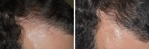 Hair Restoration Before and After Photos in Miami, FL, Patient 1641