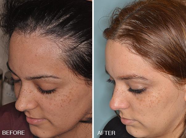 Hair Restoration Before and After Photos in Miami, FL, Patient 1578