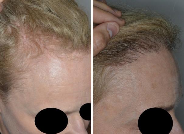 Hair Restoration Before and After Photos in Miami, FL, Patient 1660